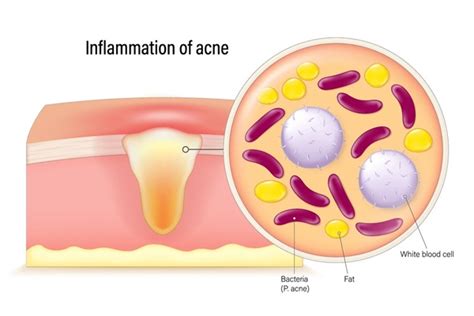 5,719 Acne Bacteria Images, Stock Photos, 3D objects, & Vectors | Shutterstock