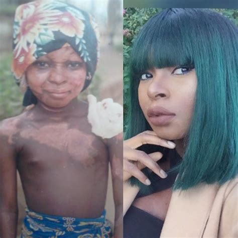 BURN SURVIVOR, SHALOM BLAC INSPIRING MAKEOVER STORY! SHE HAS THE MOST ...