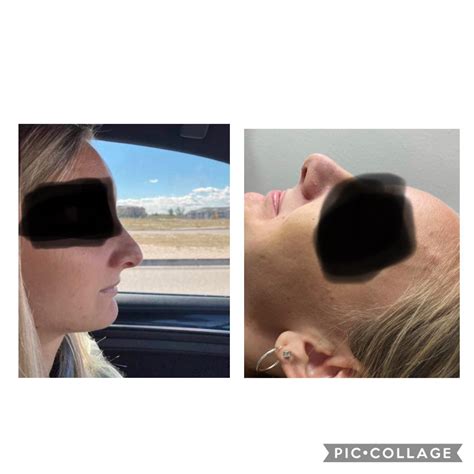 Day Of Rhinoplasty And Today One Week Post Op Scrolller