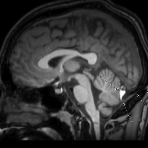 Sagittal T1 Volumetric Image Of The Brain At Midline Showed A