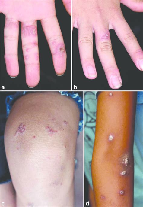 Clinical Features Of The Patient A Multiple Erythematous Papules And