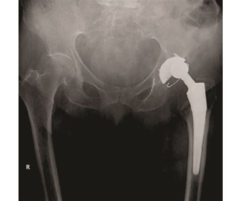 Intraprosthetic Dislocation Of Dual Mobility Total Hip Arthroplasty A