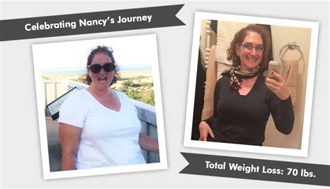 gastric sleeve  nancy obesityhelp