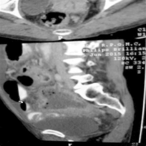 Intraoperative view of uterus with sloughed fundus of uterus, (a) arrow... | Download Scientific ...