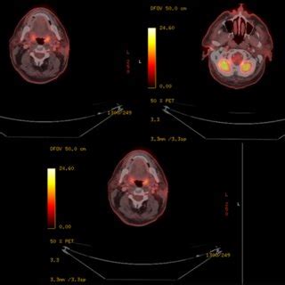 A Complete Metabolic Response Already 14 Weeks After Immunotherapy Of