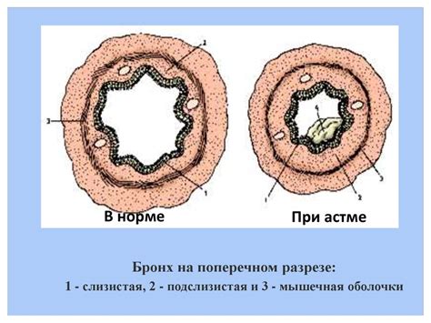 Бронхиальная астма - презентация онлайн