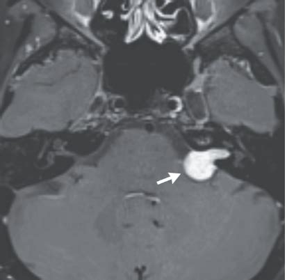 O que é schwannoma vestibular ou neurinoma do acústico