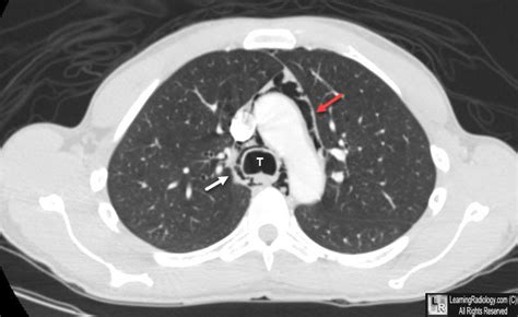 LearningRadiology - pneumomediastinum