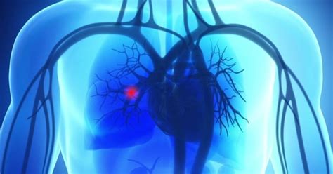 Embolia pulmonar qué es y cómo se trata