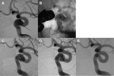 A Left Internal Carotid Angiogram Showing A Large Regular Fusiform