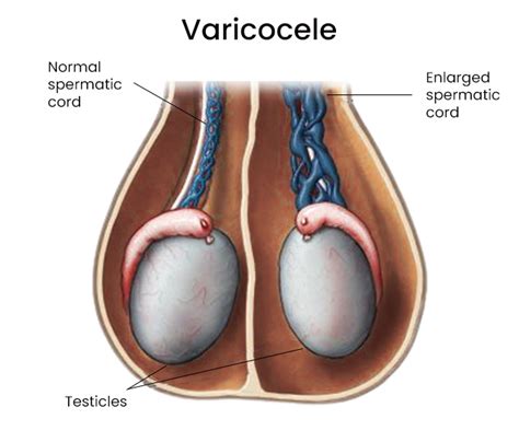 Varicocele Embolization Treatment In Downtown Brooklyn