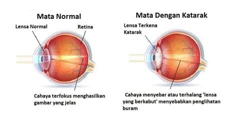 Gambar Mata Katarak Cabai