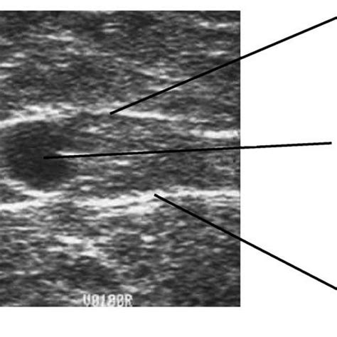 Anterior accessory saphenous vein (AASV) and the alignment sign. (A)... | Download Scientific ...