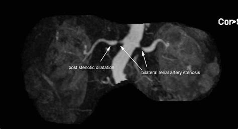 Hypertension Renovascular Cause