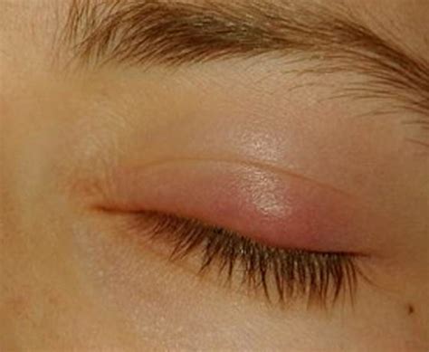 Red Spot On Eyelid Pictures Photos