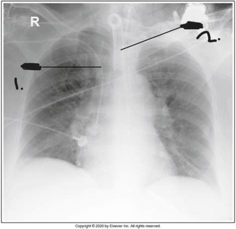 Study Guide For Chest Radiography Flashcards Quizlet