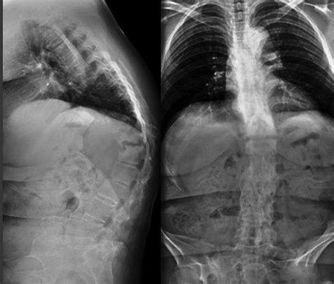 The Andersson Lesion In Ankylosing Spondylitis Bone And Joint