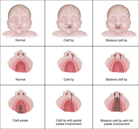 Brush Up On Your Knowlege of Cleft Palates with Great Web Resources ...