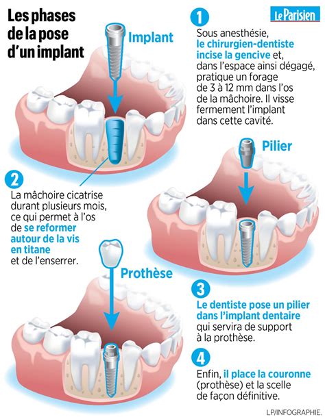 Comment Se D Roule Pose D Implant Dentaire Et La Chirurgie The Best