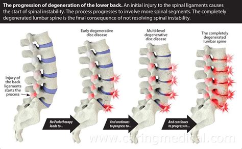 Non Surgical Treatment Options For Lumbar Spinal Stenosis Caring