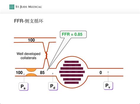 Ffr血流储备分数word文档在线阅读与下载无忧文档