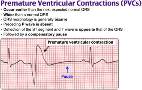 Premature Beats Flashcards Quizlet