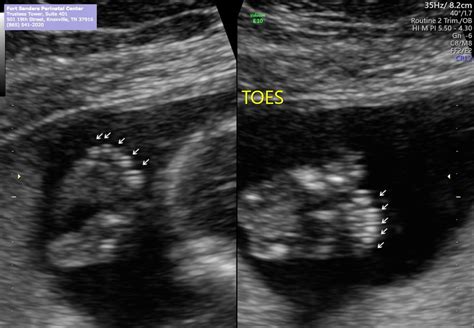 Lets See Our Week Ultrasounds July Babies Forums What