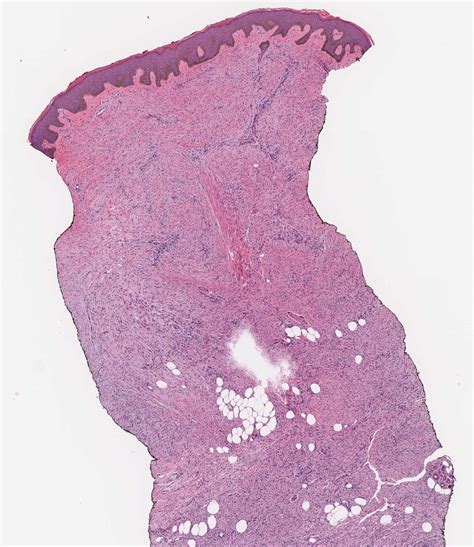 Pathology Outlines Dermatofibrosarcoma Protuberans Dfsp