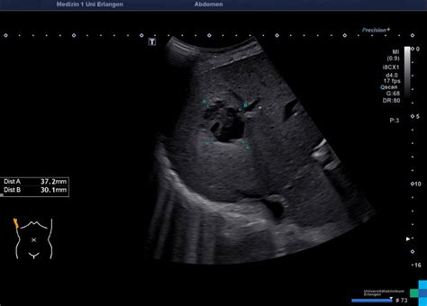 Liver Abscess Atlas Of Ultrasound