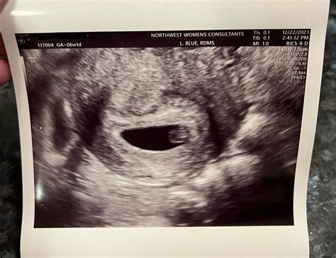 5w5d Ultrasound August 2024 Babies Forums What To Expect