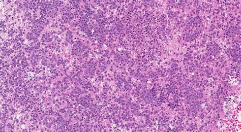 Primary CNS Diffuse Large B Cell Lymphoma Ottawa Atlas Of Pathology