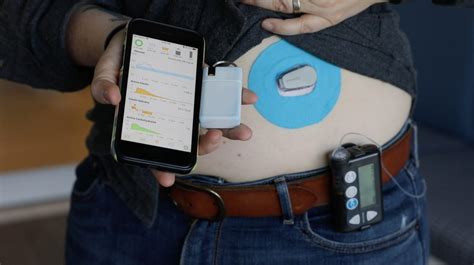 Artificial Pancreas Device Systems Apds Market Research Report