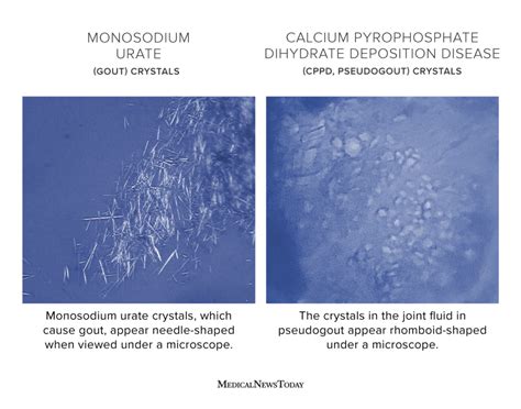 Gout crystals: Types, treatment, and prevention