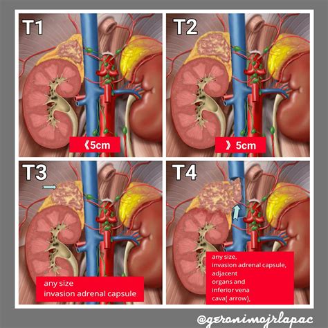 Adrenal Gland Tumor