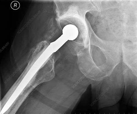 Total Hip Replacement X Ray