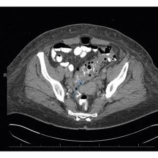 Axial Computed Tomography Of The Abdomen And Pelvis Demonstrating