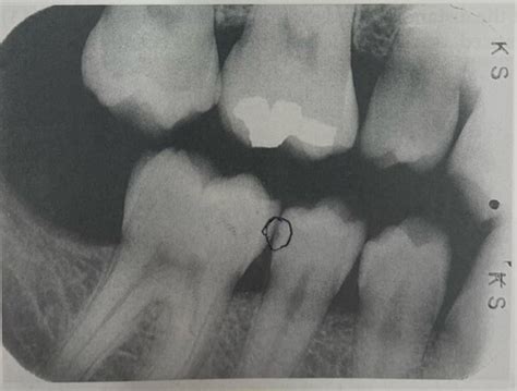 Chapter 33 Classes Of Caries Flashcards Quizlet