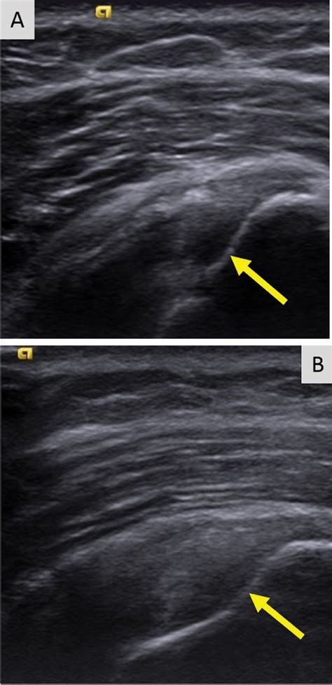 Musculoskeletal Ultrasonography Basics Cleveland Clinic Journal Of