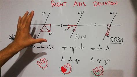 Cvs Physiology Right Axis Deviation Cardiac Axis Determination