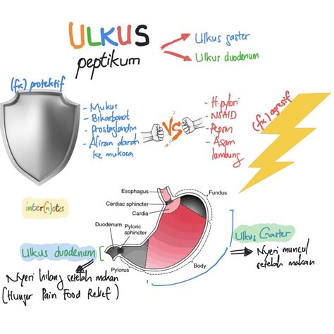 Ulkus Peptikum Gaster Dan Duodenum Ternotes