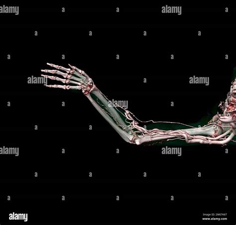 Brachial Arteries Of The Arm With Upper Extremity Bone 3d Rendering