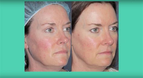 Rosacea Redness Treatment Medspa San Diego Ca Clderm