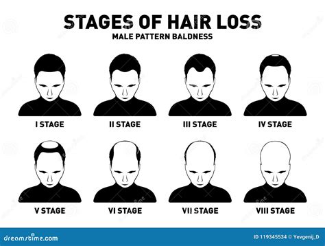 Hair Loss. Stages and Types of Male Hair Loss. Male Pattern Baldness ...