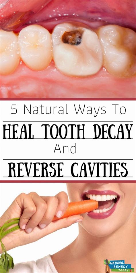 How To Reverse Tooth Decay On Front Teeth