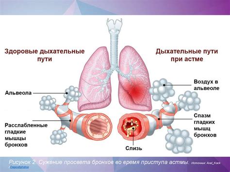Лечебная физическая культура при бронхиальной астме - презентация онлайн