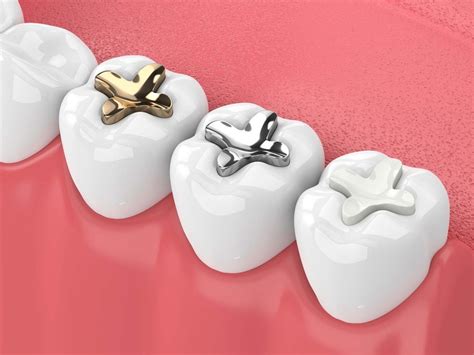 Inlays And Overlays Nerang Gold Coast Dental Studio