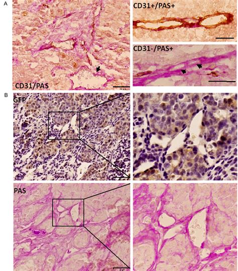 Vasculogenic Mimicry In The Dsred Llccm Derived Tumor A Tumor