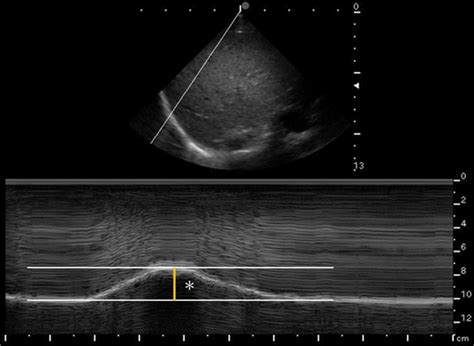 diaphragmatic excursion procedure  donna champion blog