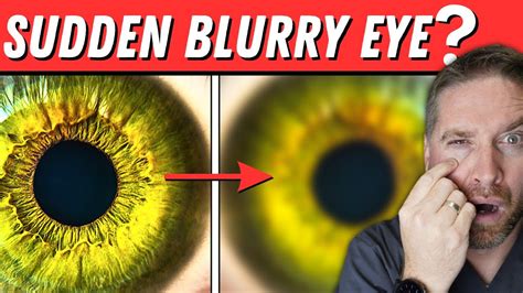 Sudden Blurry Vision In One Eye 5 Causes Youtube