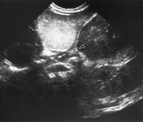 Gastroesophageal Junction Ultrasound